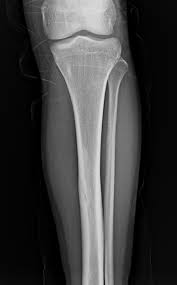 Image result for Tibia Stress Fracture