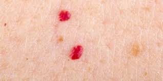 Yuk simak penjelasan lengkapnya sebagai infeksi dapat menyebabkan berbagai jenis bintik merah pada bayi, yang paling umum akibat jamur atau virus yang muncul di kulit lengan dan kaki. Jangan Abaikan Jika Ada Tahi Lalat Merah Di Tubuh Dream Co Id