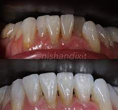 Take your smile to the next level with braces from a trusted provider. How Long Does Invisalign Take Blue Court Dental Centre Harrow