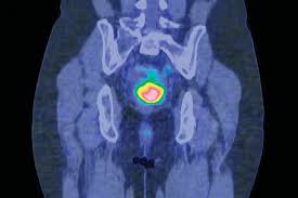 It's also important to follow recommended screening. Clinical Review Cervical Cancer Gponline