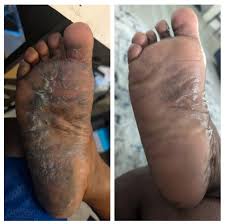 Image result for pompholyx soles of feet