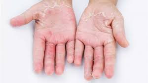 Merendam jari adalah salah satu cara mengobati cantengan di jari tangan yang paling sederhana. Mengatasi Dermatitis Kontak Pada Ibu Hamil Kumparan Com