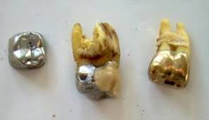 Il colore anormale dei denti non è uguale all'annerimento o ingiallimento dei i nuotatori che trascorrono gran parte del loro tempo in piscine eccessivamente clorate possono perdere lo smalto dai denti, così come le. Che Fine Fanno I Denti In Oro Una Volta Estratti Vengono Raffinati O Venduti Sottobanco Cronache