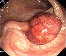 Tumoare benignă care se formează pe unele mucoase. Dickdarmpolyp Wikipedia