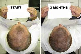 Alexander to learn more about his technique, experience and hair transplant philosophy. Dr Alexander Hairloss