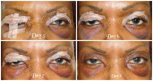 Pin On Blepharoplasty Eyelid Surgery