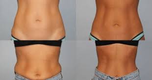 Pin By Newport Beach Medspa On Coolsculpting Love Handle Workout Mommy Workout Love Handles