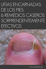 Unas Encarnadas De Los Pies 6 Remedios Caseros Sorprendentemente Efectivos Salud Unas Encarnadas Unas Enterradas Remedios Para Remedios Caseros
