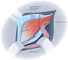 Image result for Groin Disruption