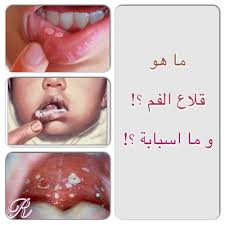 القلاع او داء المبيضات الفموي هو حالة مرضية تتراكم فيها فطريات كانديدا على بطانة الفم حيث تظهر تقرحات بيضاء على اللسان او باطن الخد وت Tough Conditioner Pill