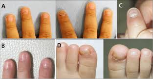 Image result for Beau lines feet