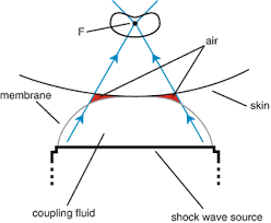 We did not find results for: Shock Wave Lithotripsy Springerlink