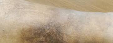 Cellulitis is a potentially dangerous bacterial infection that affects the deeper layers of the skin, including the dermis, or second layer of skin, and the cellulitis can develop anywhere on the body, but in adults it most commonly affects the skin of the lower legs. Cellulitis Johns Hopkins Medicine