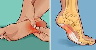How To Treat And Prevent Plantar Fasciitis At Home Our Daily Ideas With Images Foot Remedies Swollen Feet Remedy Healing Plantar Fasciitis