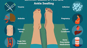 Damage to the medial ligament. Common Causes Of Foot And Ankle Swelling