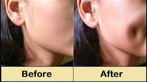 One is that it's a product of shorter muscles around the mouth, but the more popular theory is that it's. How To Get Dimples Fast Naturally Simple Facial Exercise To Get Dimples Without Surgery Youtube