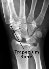 Image result for Trapezoid Bone