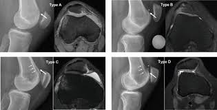 Blood supply a large portion of the levator scapulae muscle is vascularized by two branches of the thyrocervical trunk ; What Sports Medicine Practitioners Should Know About Imaging For Femoro Patellar Pathologies Sems Journal
