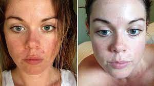 Although most wounds heal naturally with time one reviewtrusted source of 27 animal model studies showed that antibacterial treatments played a positive role in helping wounds heal faster. How To Heal Your Skin Within 24 Hours Raw Nourishment Youtube