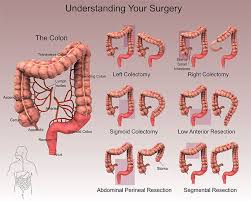 Colectomy Google Search Diverticulitis Colectomy Disorders
