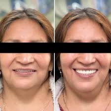 Properly made dentures can restore lost volume and make you look younger.  Beautiful and subtle transformation for our patient. #dentistry #dentist  #dental #smile #teeth #dentista #odontologia #cosmeticdentistry #dentalcare  #dentistryworld #tooth ...