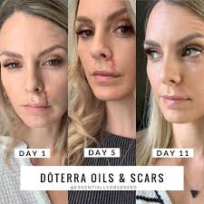 UPDATE ON MY SURGERY God's blessings to each and everyone of you. The  healing is going great. I see more and more every day. I have six (6) drops  to be applied