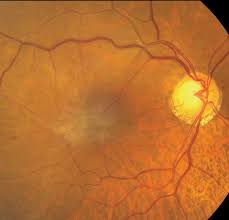 Manic Foveal Depression