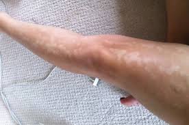After each treatment, you'll notice the difference. How To Correct White Spots After Laser Treatment Photo