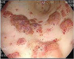 It usually appears as tumors on the skin or on mucosal surfaces such as inside the mouth, but tumors can also develop in other parts of the body (including the lymph nodes, lungs, or digestive tract).the abnormal cells of kaposi sarcoma cause purplish, reddish blue, or dark brown/black skin lesions. Kaposi Sarcoma An Unusual Cause Of Gastrointestinal Bleeding Bmj Case Reports
