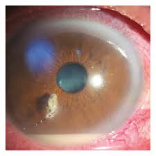 Image result for Eye Foreign Body