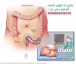 داء الأمعاء الإلتهابي Ibd الأسباب والاعراض والعلاج في تايلند