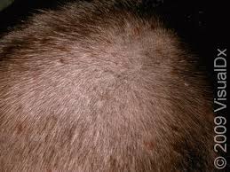Image result for white scabs on the head in children