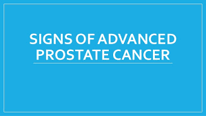 Advanced prostate cancer can cause symptoms such as bone pain and problems urinating. Signs Of Advanced Prostate Cancer