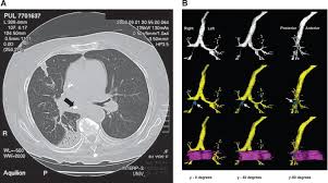 Image result for Broncholithiasis