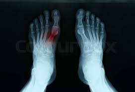 Image result for Foot XRay