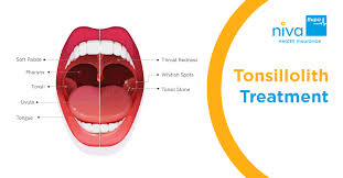 Image result for Tonsillolith