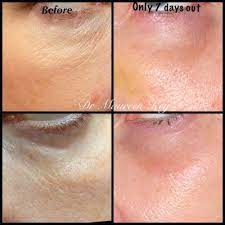 Hollow eyes sir, sir please calm down! Prf Under Eye Prf Treatment For The Face New Look Solutions
