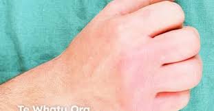 Image result for Erysipeloid