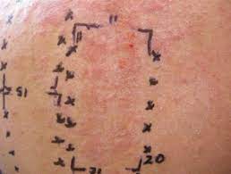 Patch Tests Dermnet Nz