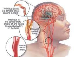Here Are The Differences Between A Heart Attack Stroke And Cardiac Arrest This May Help You Carotid Artery Arteries Stroke Prevention