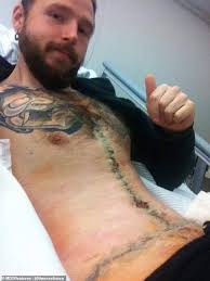 Total left knee replacement scar. La Man Loses 330lbs And Becomes Model After Covering Up Weight Loss Surgery Scars With Tattoos Daily Mail Online