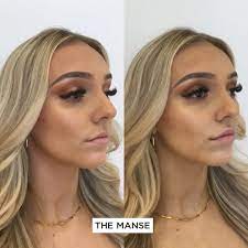 Lip Fillers Best Clinic Sydney For Dermal Fillers