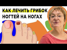 как вылечить грибок на ногах в домашних условиях видео Kak Lechit Gribok Nogtej Na Nogah V Domashnih Usloviyah Youtube V 2020 G Nogti Na Nogah Nogti Mikoz
