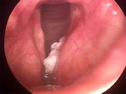 Most often, a cancerous tumor is localized in the vestibular larynx. Cancer Sean Parker Institute For The Voice