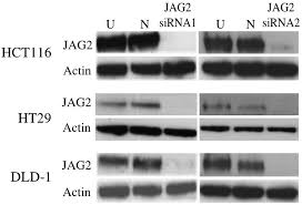 Colorectal cancer doesn't have early warning signs, so it's important to get checked. Jagged 2 Silencing Inhibits Motility And Invasiveness Of Colorectal Cancer Cell Lines