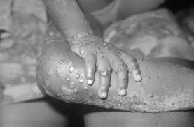 Worse, monkeypox in the congo basin is evolving so that it can spread from one person to another. Monkeypox Wikipedia