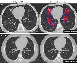 CT Scan Analysis
