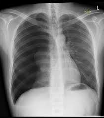 Image result for Pneumothorax