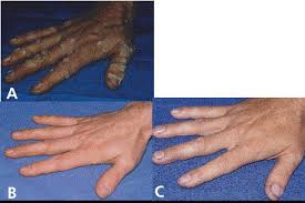 Recalcitrant cutaneous warts treated with recombinant quadrivalent human papillomavirus vaccine (types spontaneous remission of recalcitrant warts in girls after human papillomavirus vaccination. Resolution Of Recalcitrant Hand Warts In An Hiv Infected Patient Treated With Potent Antiretroviral Therapy Journal Of The American Academy Of Dermatology