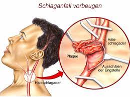 Erkrankungen Der Halsschlagader Jetzt Schlaganfall Vorbeugen